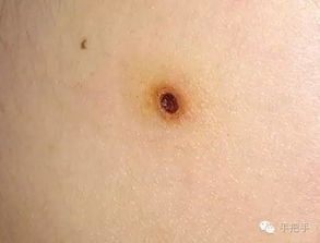 電離子點痣后注意事項,點痣注意事項點痣忌口,點痣后注意事項