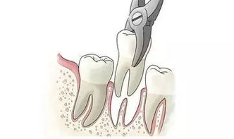 拔智牙后的注意事項(xiàng)及飲食,拔智牙后注意事項(xiàng)與禁忌癥,拔智牙之后注意事項(xiàng)與禁忌癥