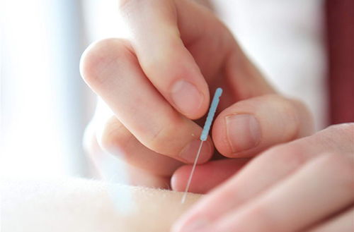 針灸治療后的注意事項(xiàng)