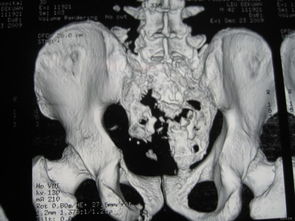 骶尾椎骨折注意事項(xiàng)