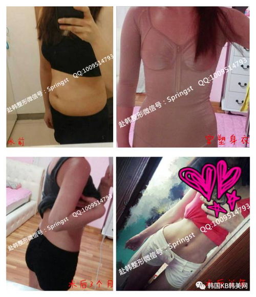 做手臂吸脂后都有哪些注意事項