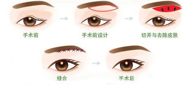 兒童上瞼下垂手術(shù)后注意事項(xiàng)