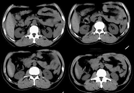 搬運肝脾破裂注意事項