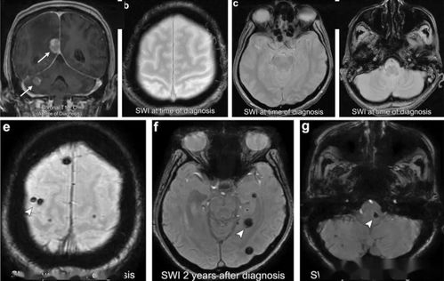 腦瘤,放療,注意事項