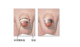 做完包皮環(huán)切注意事項(xiàng)