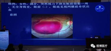 視網(wǎng)膜色變注意事項(xiàng)
