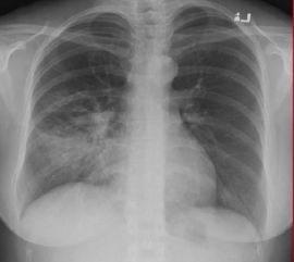 x光胸片注意事項(xiàng)