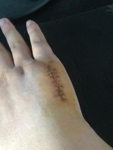 手掌骨頭斷了注意事項