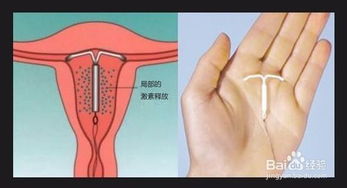 女性上完環(huán)注意事項(xiàng),上完避孕環(huán)需要注意什么,上環(huán)后應(yīng)該注意什么事項(xiàng)