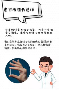 皮下埋植術后注意事項,皮下埋植避孕注意事項,皮下埋植避孕術后注意事項