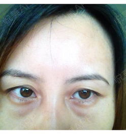 做了內(nèi)吸眼袋需要注意,內(nèi)切眼袋術(shù)后注意事項(xiàng),內(nèi)切眼袋熱敷注意事項(xiàng)