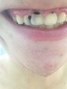 撥門牙要注意事項