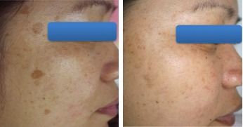 激光祛痘印后應該注意些什么,做完激光祛痘印需要注意什么,點陣激光去痘印后注意事項