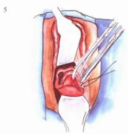 宮頸口裂傷后注意事項