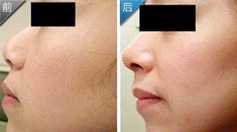 尿酸,注意事項(xiàng),鼻子