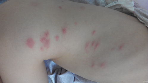 螨蟲(chóng)皮炎注意事項(xiàng)