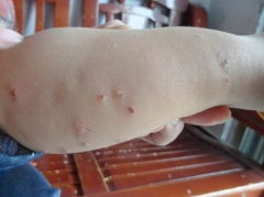 兒童尋麻疹的注意事項(xiàng)