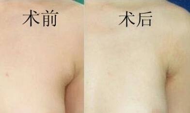 副乳切除術(shù)后注意事項,切副乳術(shù)后注意事項,吸脂術(shù)后注意事項