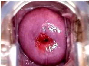 海扶刀治療宮頸糜爛后注意事項(xiàng)