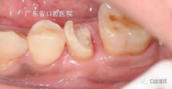 牙冠延長手術(shù)后注意什么,牙冠延長手術(shù)后多久可以裝牙套,牙冠延長手術(shù)疼嗎