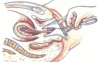 注意事項(xiàng),取環(huán),丅型環(huán)