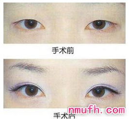 雙眼皮,武漢,術(shù)后,注意事項