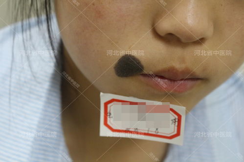 注意事項(xiàng),治療,i131