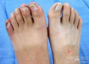 血栓性脈管炎注意事項