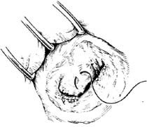 術(shù)后,置換,注意事項(xiàng),二尖瓣