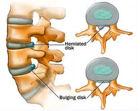 腰椎間盤突出癥患者注意事項(xiàng)