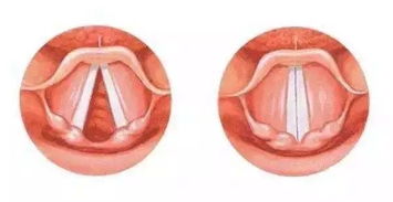 子宮息肉術(shù)后注意事項(xiàng),直腸息肉術(shù)后注意事項(xiàng),胃腸息肉術(shù)后注意事項(xiàng)