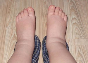 雙下肢浮腫注意事項(xiàng)