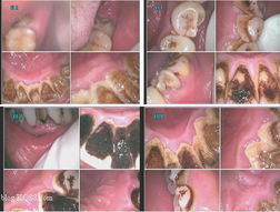 口腔放射防護(hù)注意事項(xiàng),放射防護(hù)注意事項(xiàng),放射檢查注意事項(xiàng)