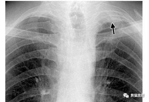 胸膜增厚注意事項