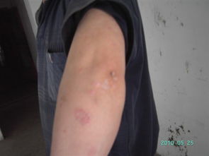 要注意,事項,龍須瘡