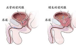 化療,注意事項,前列腺癌