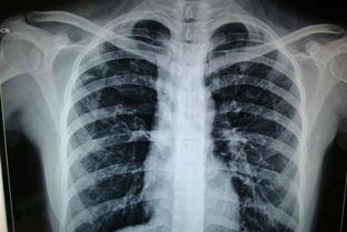 x光胸片注意事項(xiàng),拍x光胸片注意事項(xiàng),拍胸片注意事項(xiàng)