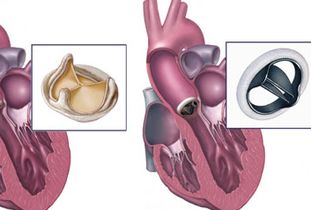 二尖瓣置換術(shù)后注意事項(xiàng)