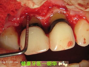 牙冠延長手術(shù)后注意事項