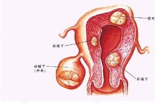 腫塊,子宮,注意事項