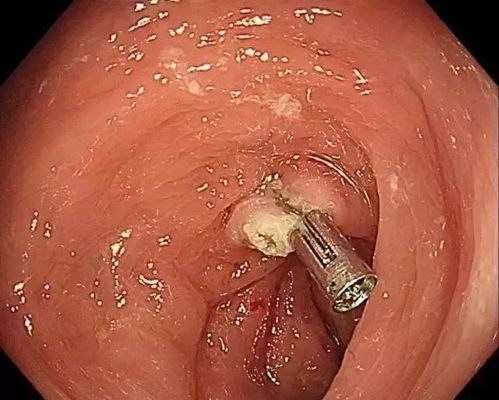 esd息肉切除后注意事項