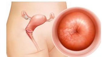 宮頸糜爛日常注意事項(xiàng)