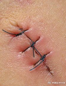 寶寶摔傷縫針注意事項(xiàng)