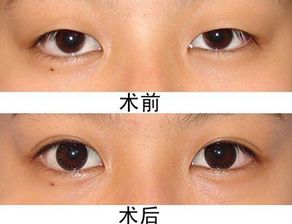 眼睛矯正后注意事項(xiàng)