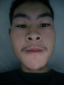 臉部祛痣后注意事項(xiàng),臉部手術(shù)切痣后注意事項(xiàng),取了痣的注意事項(xiàng)