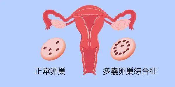 多囊卵巢孕婦注意事項(xiàng)