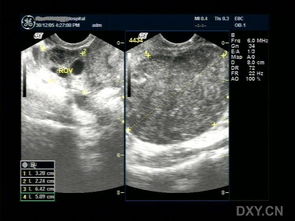 子宮左側(cè)包塊手術(shù)后注意事項(xiàng)