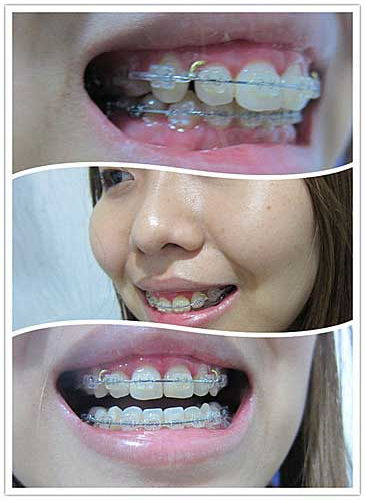 補(bǔ)牙牙套后注意事項(xiàng)