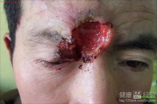 基底細胞癌術(shù)后飲食注意,基底細胞癌術(shù)后復查什么項目,基底細胞癌術(shù)后護理