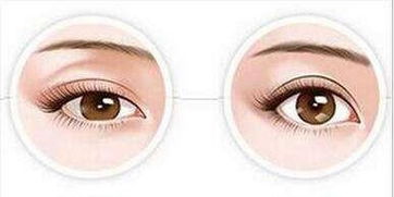 腹部抽脂術后注意事項,腿部抽脂術后注意事項,面部抽脂術后注意事項